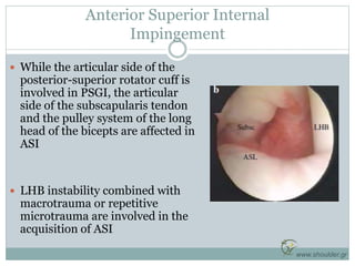 Anterior Superior Internal
Impingement
 While the articular side of the
posterior-superior rotator cuff is
involved in PS...
