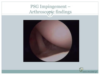PSG Impingement –
Arthroscopic findings
www.shoulder.gr
 