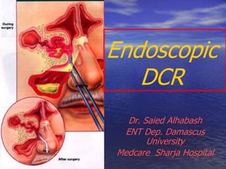 Endoscopic
DCR
Dr. Saied Alhabash
ENT Dep. Damascus
University
Medcare Sharja Hospital
 