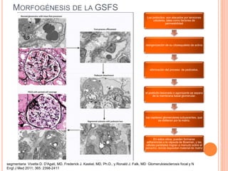Gsfs Lg glomeruloesclerosis focal y segmentaria | PPTX