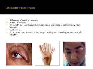 





Dislocation of buckling elements;
Scleral perforation;
Anisometropia- encircling elements may induce an average of approximately 2D of
myopia;
Strabismus;
Vortex veins could be compressed, possibly leading to choroidal detachment and IOP
elevation.

 