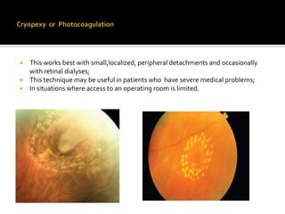 This works best with small,localized, peripheral detachments and occasionally
with retinal dialyses;
 This technique may be useful in patients who have severe medical problems;
 In situations where access to an operating room is limited.


 