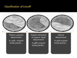 Total or superior
detachment
In 93% original
break placed…

Supero-temporal
or supero- nasal
detachment
In 98% original
break placed…

inferior
detachment
In 95% original
break placed…

 