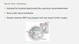 Barrier laser retinopexy :
• Indicated for localized detachments like subclinical retinal detachment
• Done under topical anesthesia
• Despite treatment RRD may progress and may require further surgery
 