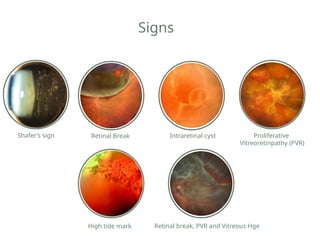Rhegmetogenous Retinal Detachment- treatment and diagnosis.pptx