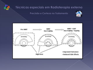 Técnicas especiais em Radioterapia externa Precisão e Certeza no Tratamento