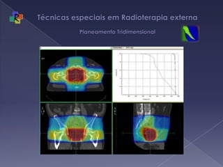 Técnicas especiais em Radioterapia externa Planeamento Tridimensional
