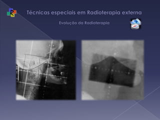 Técnicas especiais em Radioterapia externa Evolução da Radioterapia