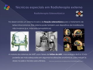 Técnicas especiais em Radioterapia externa   Radioterapia EstereotáxicaFoi desenvolvido um sistema invasivo de fixação estereotáxica para o tratamento de leões intracranianas. Este sistema pode também usar dispositivos de imobilização não invasivos (p.e. máscaras temoplásticas)A maioria dos sistemas de IMRT usam feixes de fotões de 6MV, mas energias de 8 a 10 MV poderão ser mais adequadas em algumas localizações anatómicas, para reduzir as doses na pele e tecidos subcutâneos.       http://www.cancernetwork.com/display/article/10165/95568?pageNumber=4