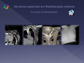 Técnicas especiais em Radioterapia externa Evolução da Radioterapia