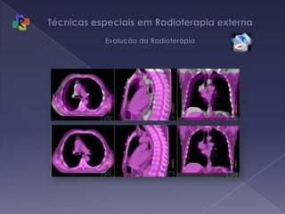 Técnicas especiais em Radioterapia externa Evolução da Radioterapia