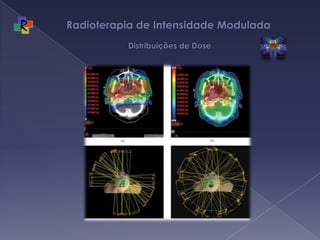 Radioterapia de Intensidade Modulada  Distribuições de Dose