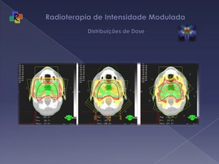 Radioterapia de Intensidade Modulada  Distribuições de Dose