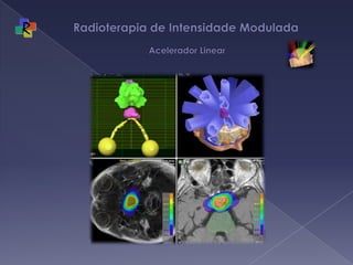 Radioterapia de Intensidade Modulada  Acelerador Linear