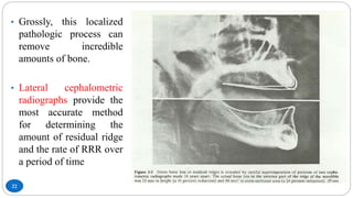 22
• Grossly, this localized
pathologic process can
remove incredible
amounts of bone.
• Lateral cephalometric
radiographs provide the
most accurate method
for determining the
amount of residual ridge
and the rate of RRR over
a period of time
 