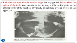 23
• RRR does not stop with the residual ridge, but may go well below where the
apices of the teeth were, sometimes leaving only a thin cortical plate on the
inferior border of the mandible or virtually no maxillary alveolar process on the
upper jaw.
 