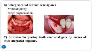 77
• B) Enlargement of denture bearing area
• Vestibuloplasty
• Ridge augmentation
• C) Provision for placing tooth root analogues by means of
osseointegrated implants.
 