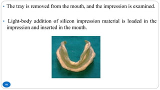 88
• The tray is removed from the mouth, and the impression is examined.
• Light-body addition of silicon impression material is loaded in the
impression and inserted in the mouth.
 