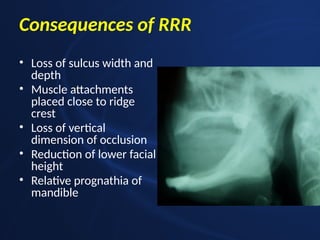 Residual ridge resorption powerpoint presentation | PPTX