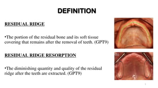 Residual Ridge Resorption in Prosthodontics .ppt