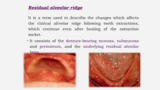 Rrrr (1).pptxppt of residual ridge resorption | PPTX