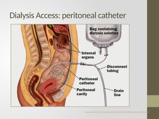 Dialysis Access: peritoneal catheter
Image courtesy of Mayo Foundation for Medical Education and Research
 