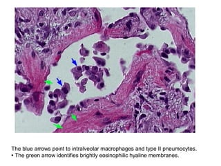 The blue arrows point to intralveolar macrophages and type II pneumocytes.
• The green arrow identifies brightly eosinophilic hyaline membranes.
 