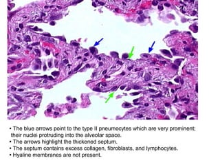 • The blue arrows point to the type II pneumocytes which are very prominent;
their nuclei protruding into the alveolar space.
• The arrows highlight the thickened septum.
• The septum contains excess collagen, fibroblasts, and lymphocytes.
• Hyaline membranes are not present.
 