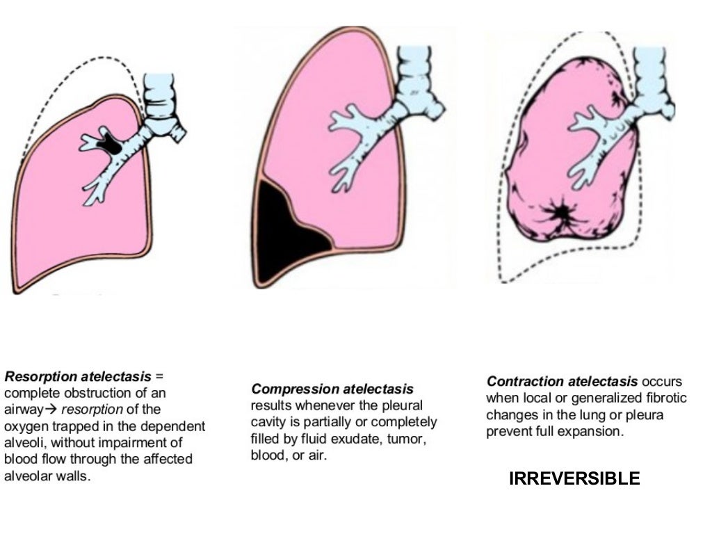 RESPIRATORY SYSTEM INTRODUCTION, ATELECTASIS, ARDS