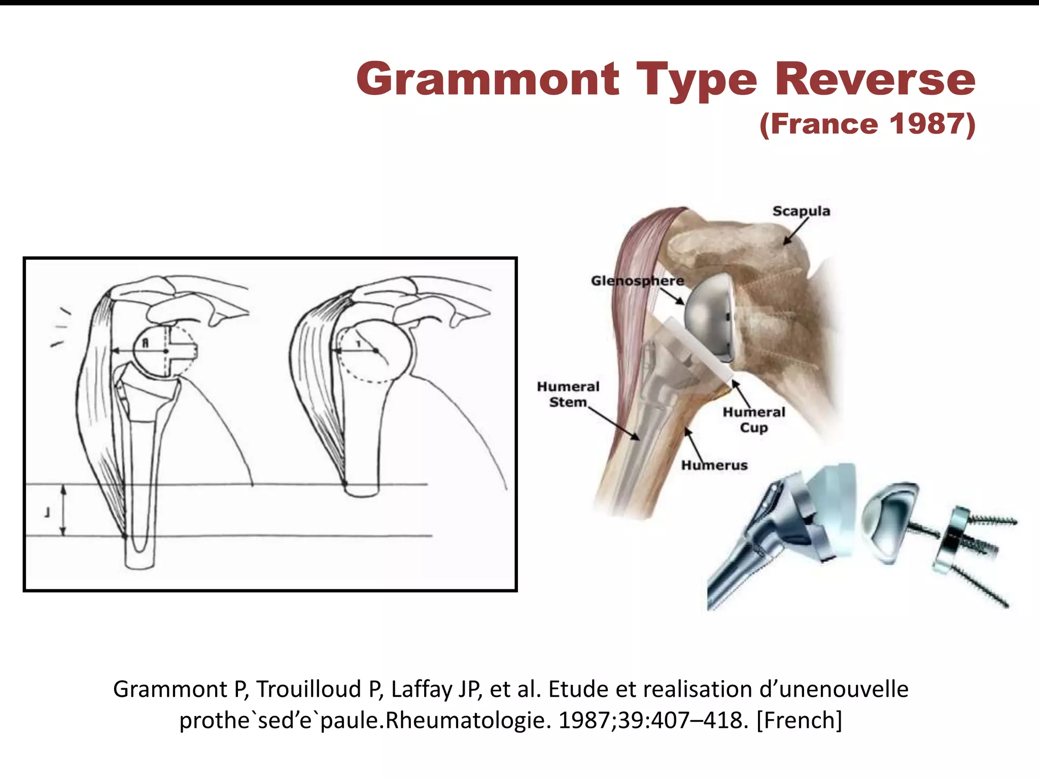 Grammont Type Reverse
(France 1987)
Grammont P, Trouilloud P, Laffay JP, et al. Etude et realisation d’unenouvelle
prothe`sed’e`paule.Rheumatologie. 1987;39:407–418. [French]
 