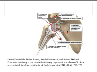 Lieven F de Wilde, Didier Poncet, Bart Middernacht, and Anders Ekelund
Prosthetic overhang is the most effective way to prevent scapular conflict in a
reverse total shoulder prosthesis. Acta Orthopaedica 2010; 81 (6): 719–726
 
