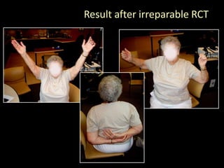 Result after irreparable RCT
 