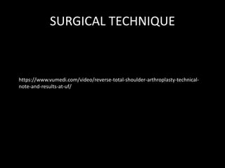 SURGICAL TECHNIQUE
https://www.vumedi.com/video/reverse-total-shoulder-arthroplasty-technical-
note-and-results-at-uf/
 