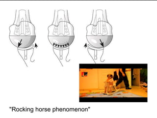 Rocking horse phenomenon
"Rocking horse phenomenon"
 