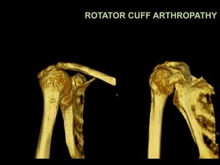 ROTATOR CUFF ARTHROPATHY
 
