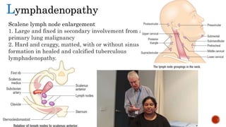 Lymphadenopathy
Scalene lymph node enlargement
1. Large and fixed in secondary involvement from a
primary lung malignancy
2. Hard and craggy, matted, with or without sinus
formation in healed and calcified tuberculous
lymphadenopathy.
 
