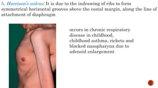 5. Harrison’s sulcus: It is due to the indrawing of ribs to form
symmetrical horizontal grooves above the costal margin, along the line of
attachment of diaphragm
occurs in chronic respiratory
disease in childhood,
childhood asthma, rickets and
blocked nasopharynx due to
adenoid enlargement
 