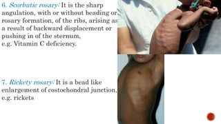 6. Scorbutic rosary: It is the sharp
angulation, with or without beading or
rosary formation, of the ribs, arising as
a result of backward displacement or
pushing in of the sternum,
e.g. Vitamin C deficiency.
7. Rickety rosary: It is a bead like
enlargement of costochondral junction,
e.g. rickets
 