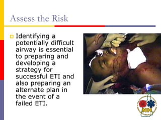 Assess the Risk
 Identifying a
potentially difficult
airway is essential
to preparing and
developing a
strategy for
successful ETI and
also preparing an
alternate plan in
the event of a
failed ETI.
 