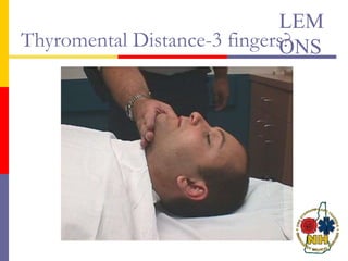 Thyromental Distance-3 fingers?
LEM
ONS
 