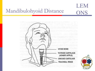 Mandibulohyoid Distance
LEM
ONS
 