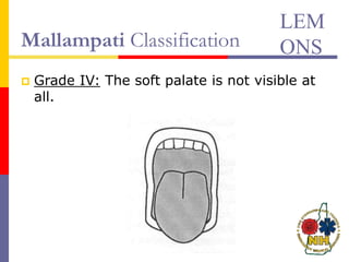 Mallampati Classification
 Grade IV: The soft palate is not visible at
all.
LEM
ONS
 