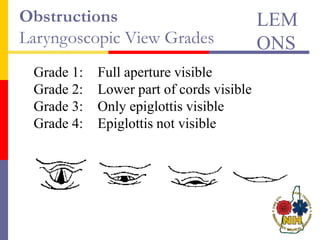 Obstructions
Laryngoscopic View Grades
Grade 1: Full aperture visible
Grade 2: Lower part of cords visible
Grade 3: Only epiglottis visible
Grade 4: Epiglottis not visible
LEM
ONS
 