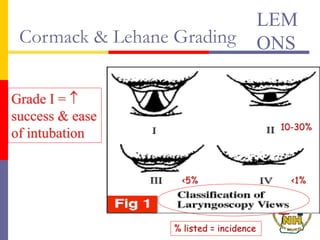 Cormack & Lehane Grading
Grade I = 
success & ease
of intubation
<1%
<5%
10-30%
% listed = incidence
LEM
ONS
 