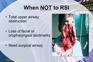 When  NOT  to RSI Total upper airway obstruction Loss of facial or oropharyngeal landmarks Need surgical airway Copyright  © 2007 ENA 