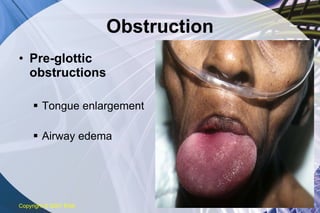 Obstruction Pre-glottic obstructions Tongue enlargement Airway edema Copyright  © 2007 ENA 