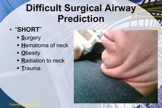 Difficult Surgical Airway Prediction “ SHORT ” S urgery H ematoma of neck O besity R adiation to neck T rauma Copyright  © 2007 ENA 