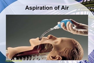 Aspiration of Air Copyright  © 2007 ENA 