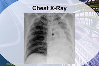Chest X-Ray Copyright  © 2007 ENA 