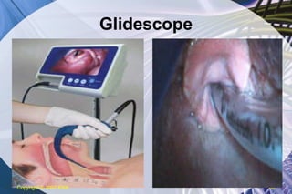 Glidescope Copyright  © 2007 ENA 